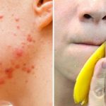 How to Treat Acne With Banana Peels