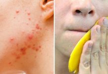 How to Treat Acne With Banana Peels