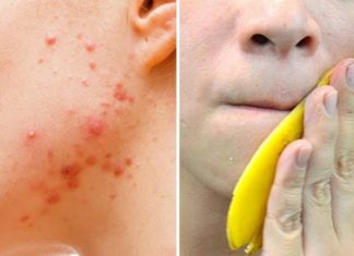 How to Treat Acne With Banana Peels