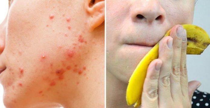 How to Treat Acne With Banana Peels - BeautyHealthRecipes 2024 | PopcornTime