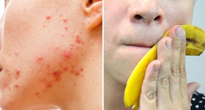 How to Treat Acne With Banana Peels