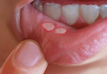 Canker Sores In The Mouth: Here Is How To Naturally Get Rid Of Them In A Matter Of Minutes Without Using Any Medicine
