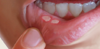 Canker Sores In The Mouth: Here Is How To Naturally Get Rid Of Them In A Matter Of Minutes Without Using Any Medicine