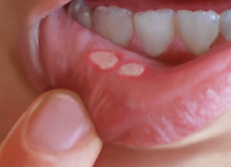 Canker Sores In The Mouth: Here Is How To Naturally Get Rid Of Them In A Matter Of Minutes Without Using Any Medicine