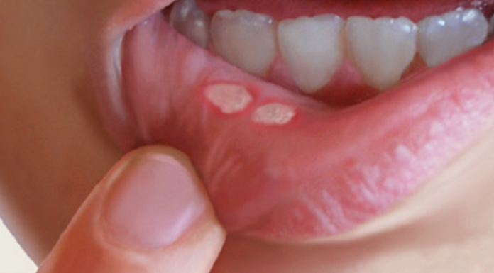 Canker Sores In The Mouth: Here Is How To Naturally Get Rid Of Them In A Matter Of Minutes Without Using Any Medicine