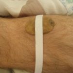 Potato-on-Leg-with-Tape-2-300×300