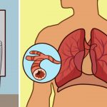 asthma