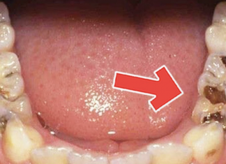 How To Get Rid of Tooth Diseases And Decay Easily At Home