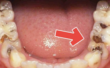 How To Get Rid of Tooth Diseases And Decay Easily At Home