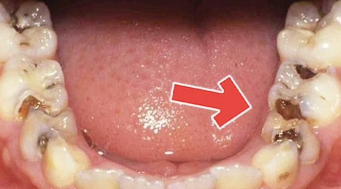 How To Get Rid of Tooth Diseases And Decay Easily At Home - Beauty 2024 | PopcornTime