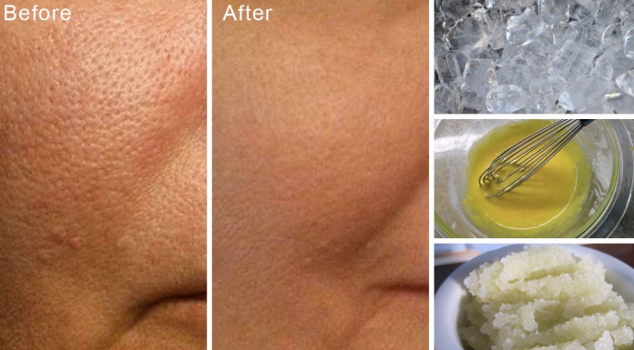 How to easily lessen the appearance of big pores