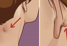 Natural remedies to get rid of sebaceous or epidermoid cyst