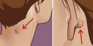 Natural remedies to get rid of sebaceous or epidermoid cyst