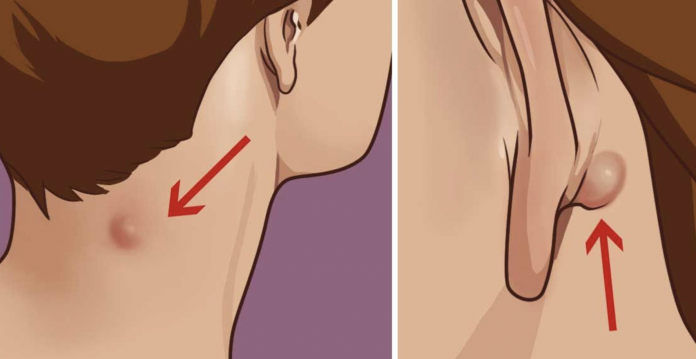 Natural remedies to get rid of sebaceous or epidermoid cyst - Health 2024 | PopcornTime