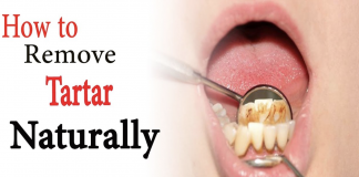 Natural remedies that are going to help you deal with tartar