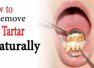 Natural remedies that are going to help you deal with tartar
