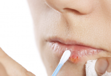 Heal cold sores using homemade lip balms