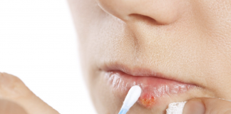 Heal cold sores using homemade lip balms