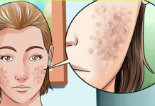 How to get rid of face scars and spots with a face mask