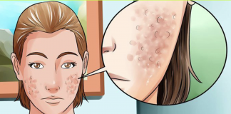 How to get rid of face scars and spots with a face mask