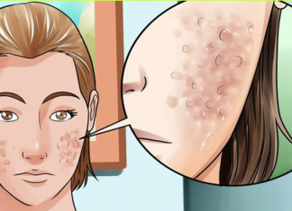 How to get rid of face scars and spots with a face mask