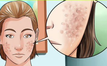 How to get rid of face scars and spots with a face mask