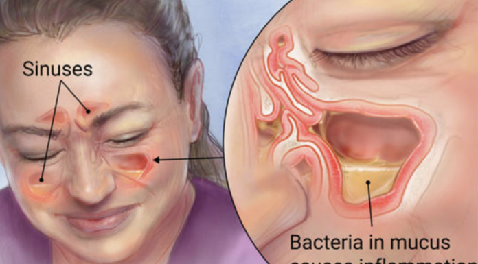 How Clear Out Your Sinuses Using Only Your Fingers In Seconds