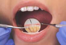 6 Natural Ways To Treat Tooth Infection