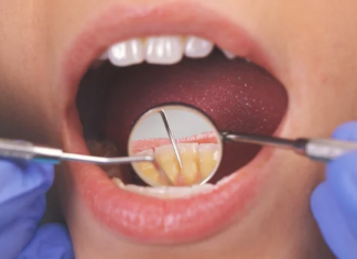 6 Natural Ways To Treat Tooth Infection