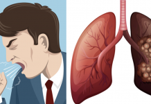 8 Early Lung Cancer Symptoms You Should Not Ignore