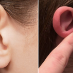 8 natural ways to treat pimples in your ears