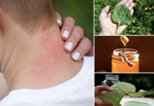 4 Ways To Get Rid Of Mosquito Bites