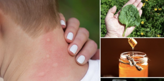 4 Ways To Get Rid Of Mosquito Bites