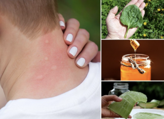 4 Ways To Get Rid Of Mosquito Bites