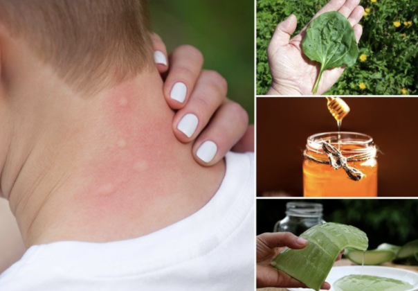 how to get rid of mosquito bites on face