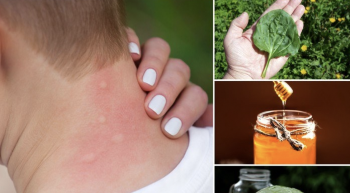 4 Ways To Get Rid Of Mosquito Bites