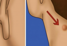 7 natural epidermoid cyst treatments