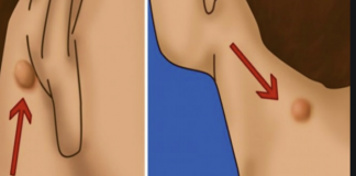 7 natural epidermoid cyst treatments