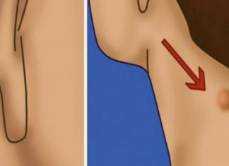 7 natural epidermoid cyst treatments