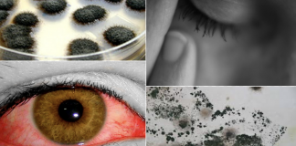 12 Signs You May Have a Mold Illness