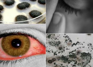 12 Signs You May Have a Mold Illness