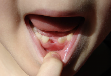 Here’s why some parents keep their children’s baby teeth