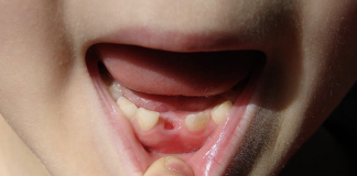 Here’s why some parents keep their children’s baby teeth