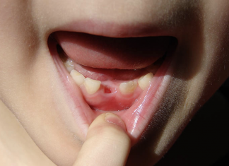 Here’s why some parents keep their children’s baby teeth