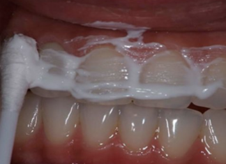 This recipe can help you whiten your teeth and terminate tartar and gingivitis