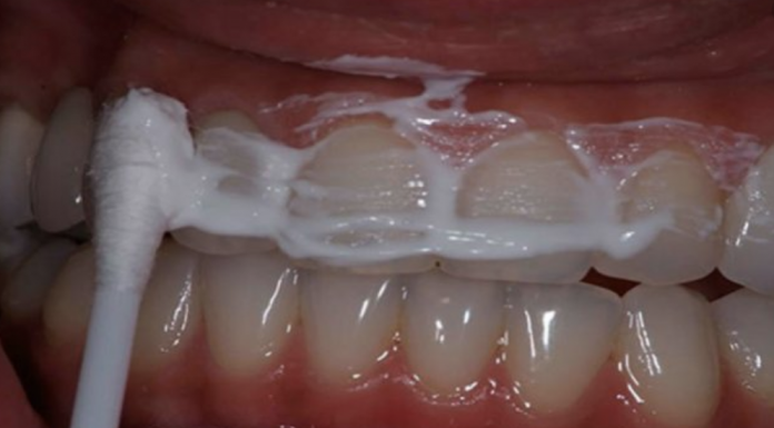 This recipe can help you whiten your teeth and terminate tartar and gingivitis