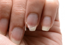 Signs and Symptoms of Calcium Deficiency