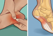 These home remedies can help you deal with water retention