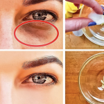 How to Get Rid of Black Circles Under Your Eyes