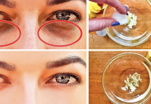 How to Get Rid of Black Circles Under Your Eyes